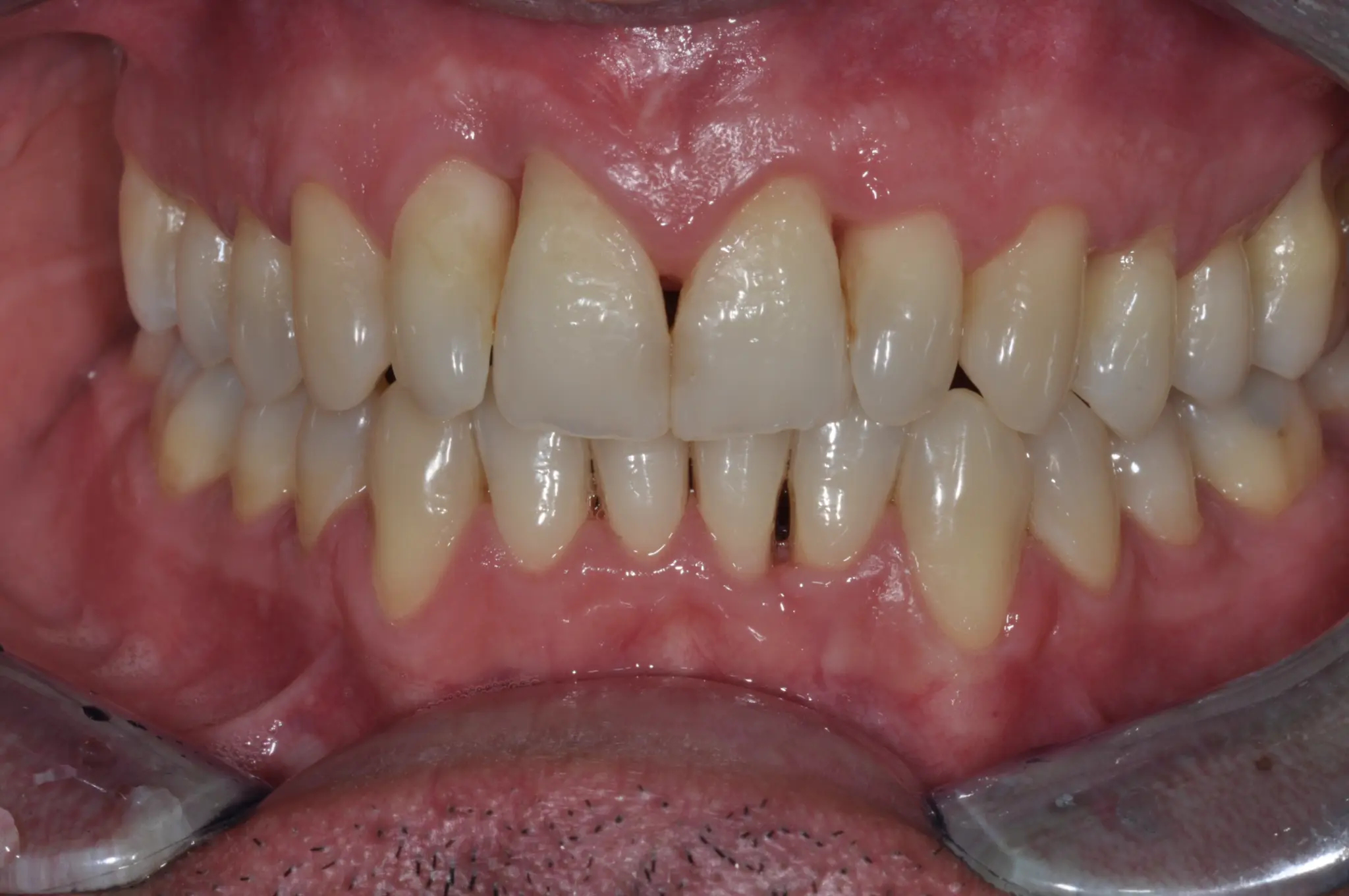 Case 2 After Treatment