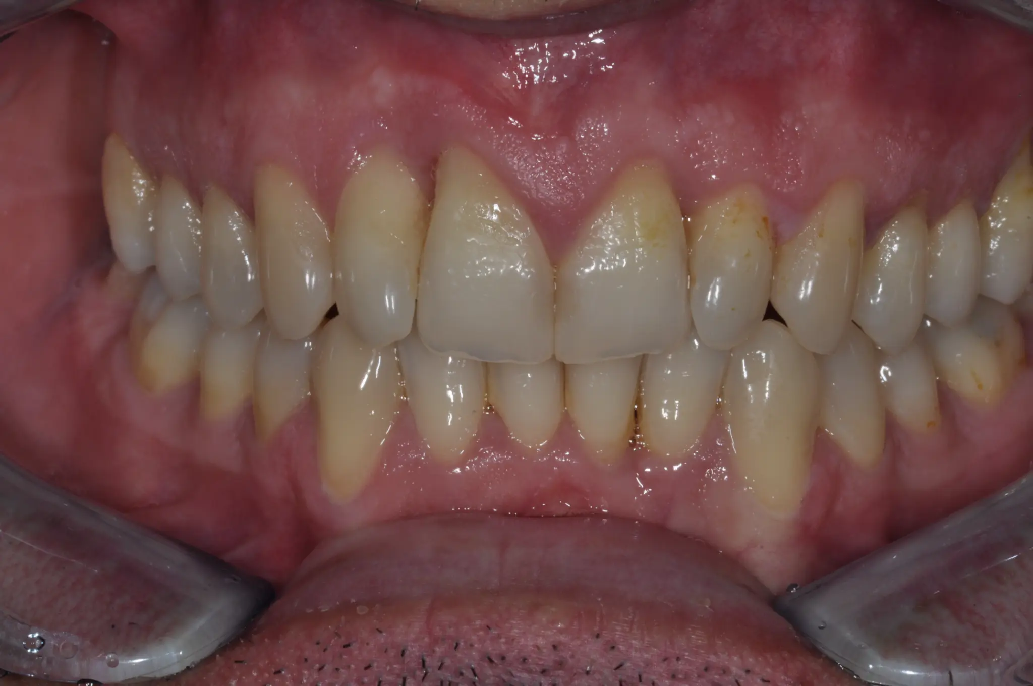 Case 2 Before Treatment