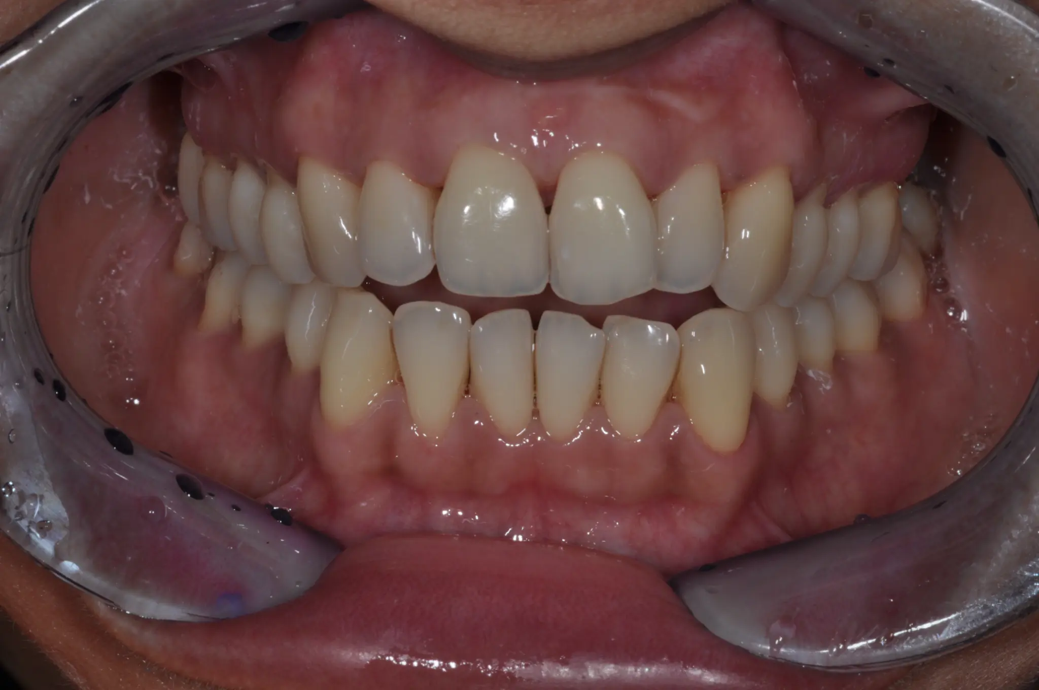 Case 3 After Treatment