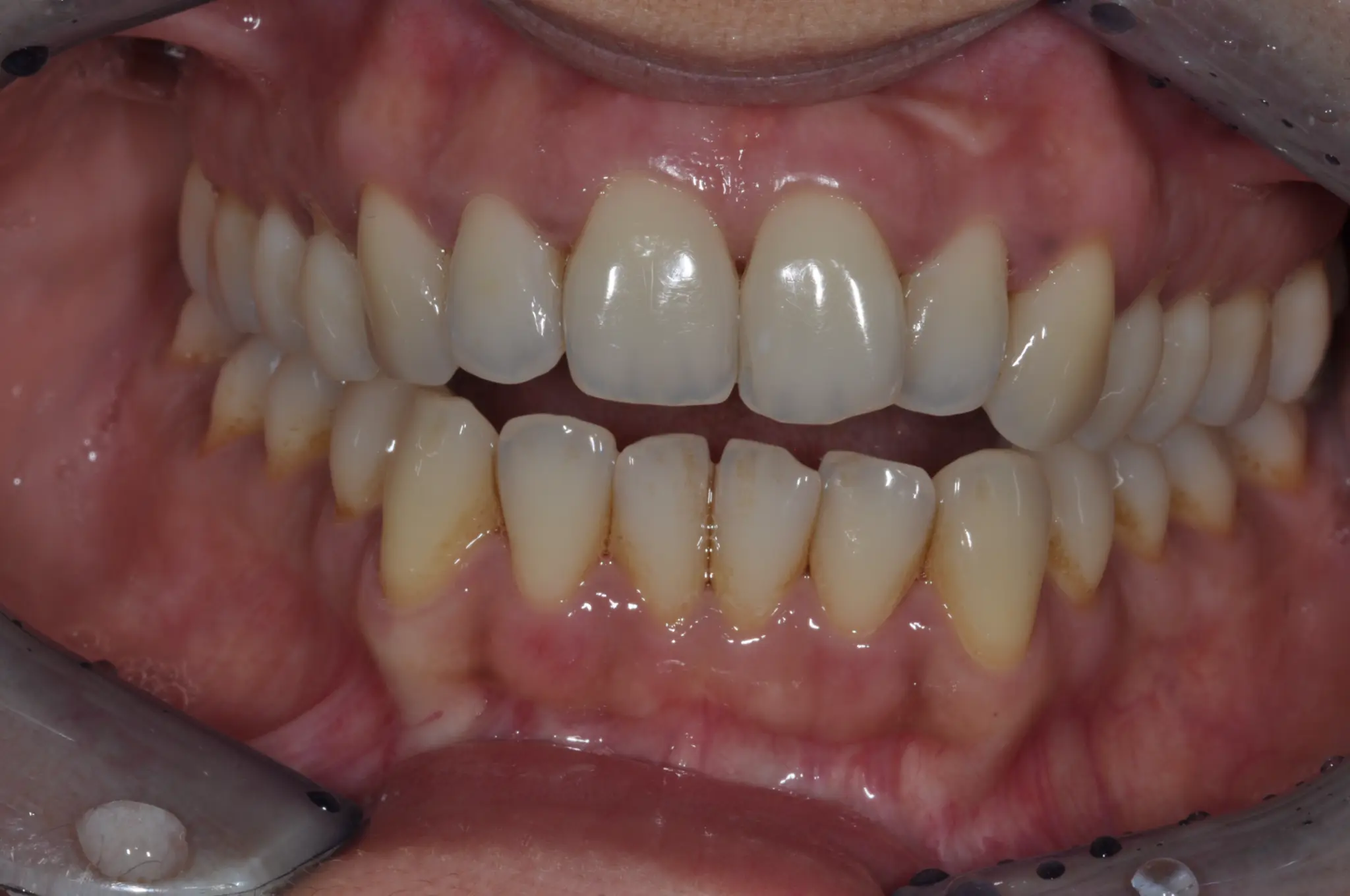 Case 3 Before Treatment