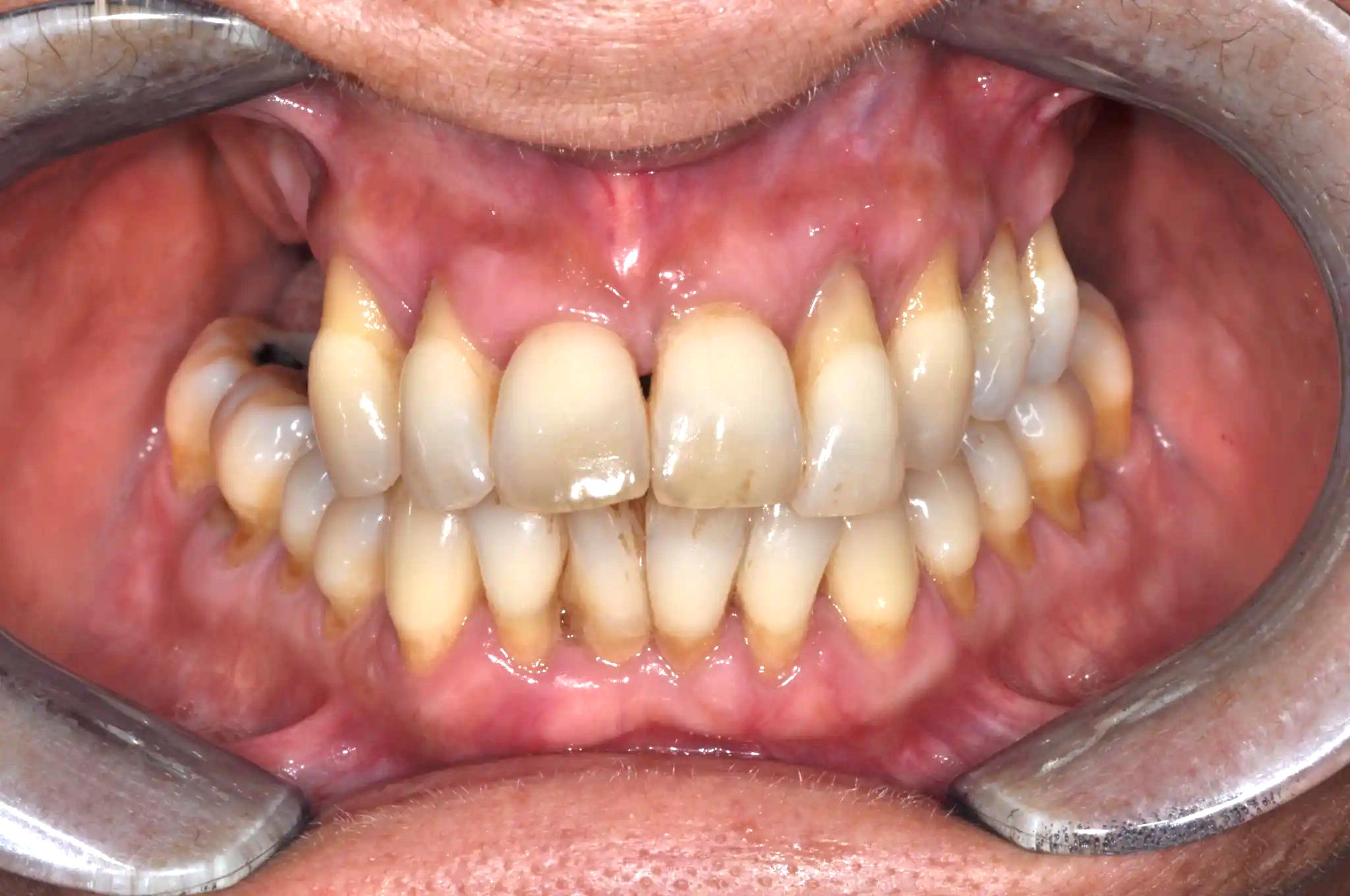 Case 5 Before Treatment