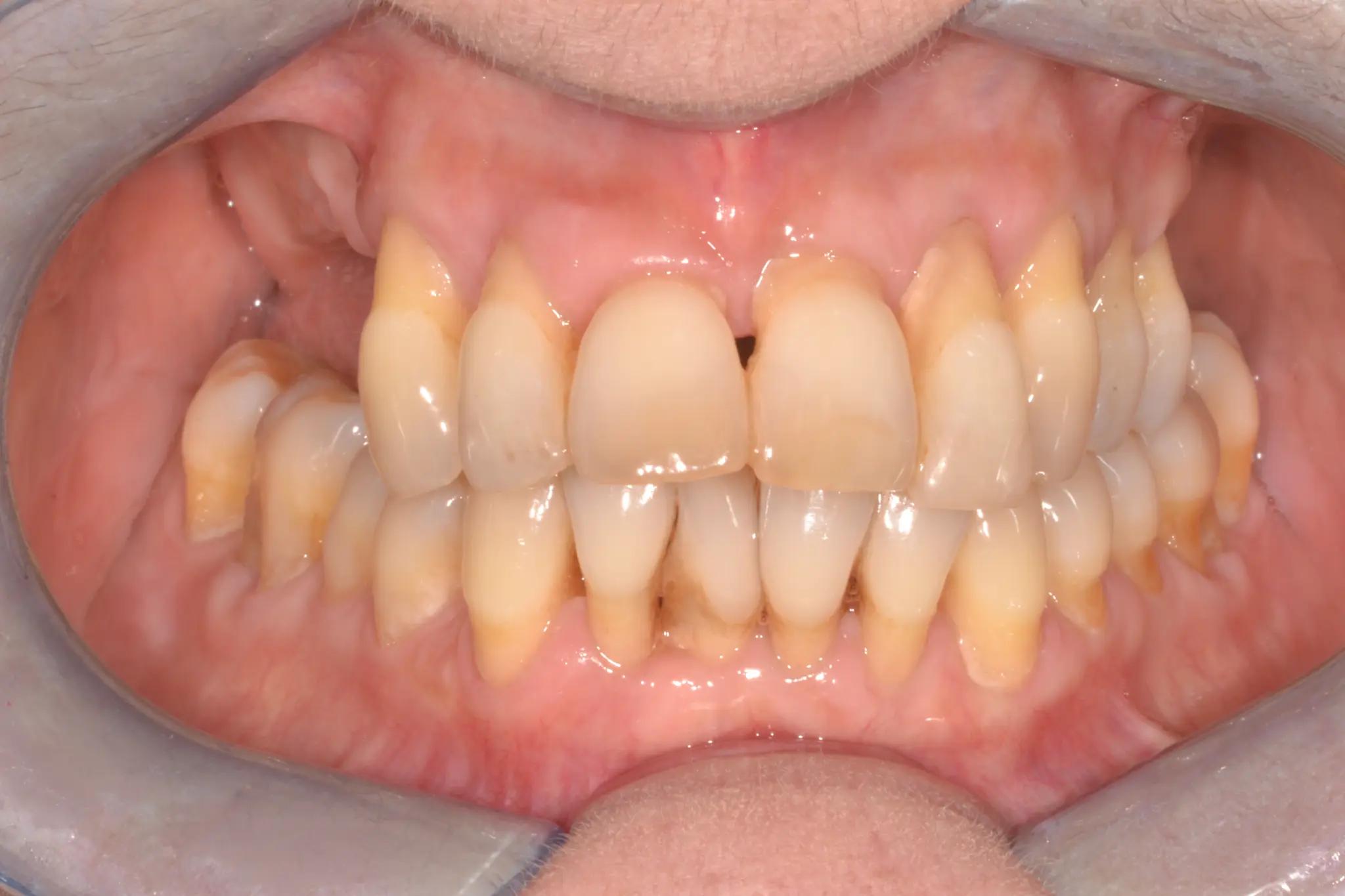 Case 5 After Treatment